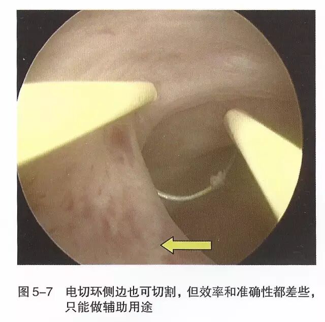 宫腔镜器械怎么组装【宫腔镜篇】器械简介_https://www.jmylbn.com_新闻资讯_第13张