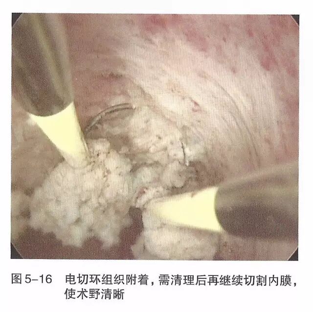 宫腔镜器械怎么组装【宫腔镜篇】器械简介_https://www.jmylbn.com_新闻资讯_第22张