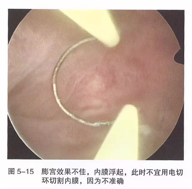 宫腔镜器械怎么组装【宫腔镜篇】器械简介_https://www.jmylbn.com_新闻资讯_第21张