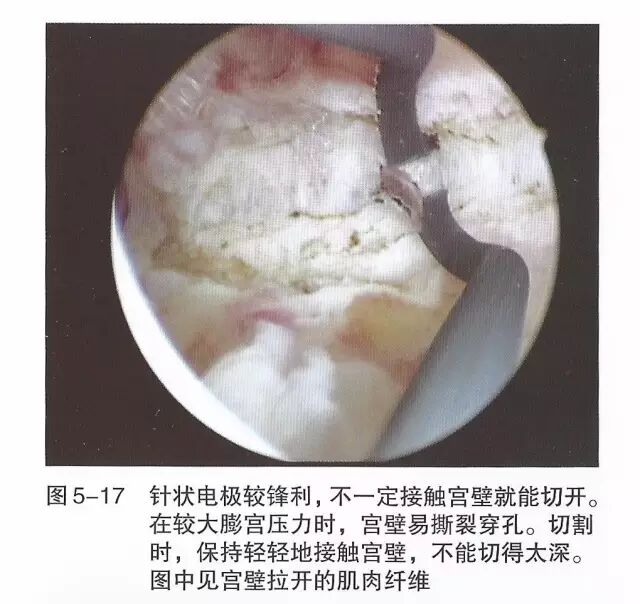 宫腔镜器械怎么组装【宫腔镜篇】器械简介_https://www.jmylbn.com_新闻资讯_第24张