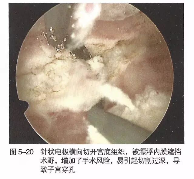 宫腔镜器械怎么组装【宫腔镜篇】器械简介_https://www.jmylbn.com_新闻资讯_第27张