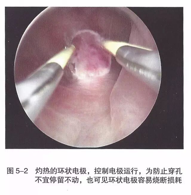 宫腔镜器械怎么组装【宫腔镜篇】器械简介_https://www.jmylbn.com_新闻资讯_第8张