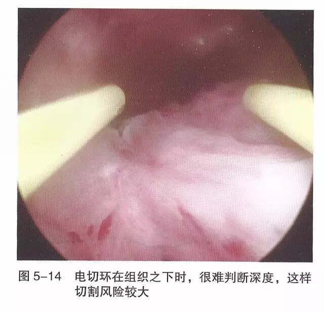宫腔镜器械怎么组装【宫腔镜篇】器械简介_https://www.jmylbn.com_新闻资讯_第20张
