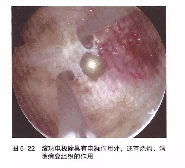 宫腔镜器械怎么组装【宫腔镜篇】器械简介_https://www.jmylbn.com_新闻资讯_第30张