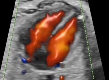 VOlusonE什么彩超机世界顶级四维彩超机美国 GE Voluson E10 BT20金标版落户吉林省吉林中西医结合医院_https://www.jmylbn.com_新闻资讯_第13张