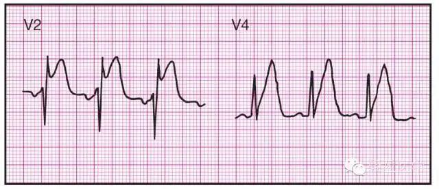 异常q波心电图表现图片