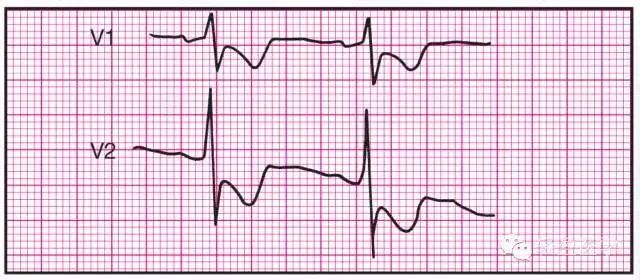 最全面的异常心电参考图,建议收藏