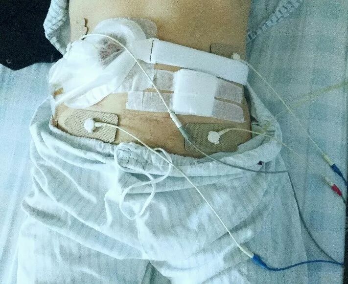 中频为什么能镇痛【干货】中频电疗(Medium Frequency)_https://www.jmylbn.com_新闻资讯_第28张