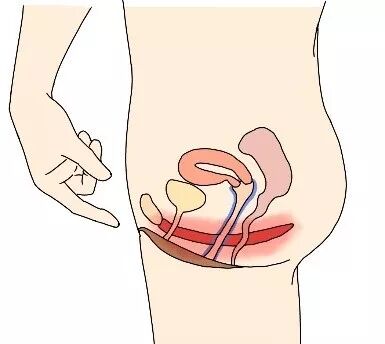 【盆底肌】把婚姻搞砸的5种盆底疾病！看完你还觉得无关紧要吗？