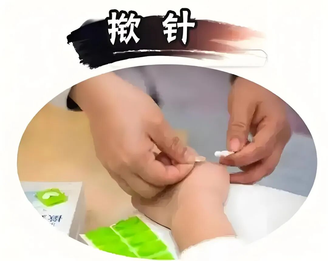 烫熨治疗贴怎么用【慈利县中医医院妇产科】中医特色治疗，呵护女性健康_https://www.jmylbn.com_新闻资讯_第22张