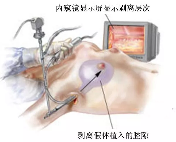 什么是内窥镜隆胸? 什么是内窥镜隆胸?