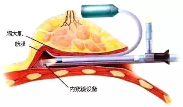 什么是内窥镜隆胸? 什么是内窥镜隆胸?