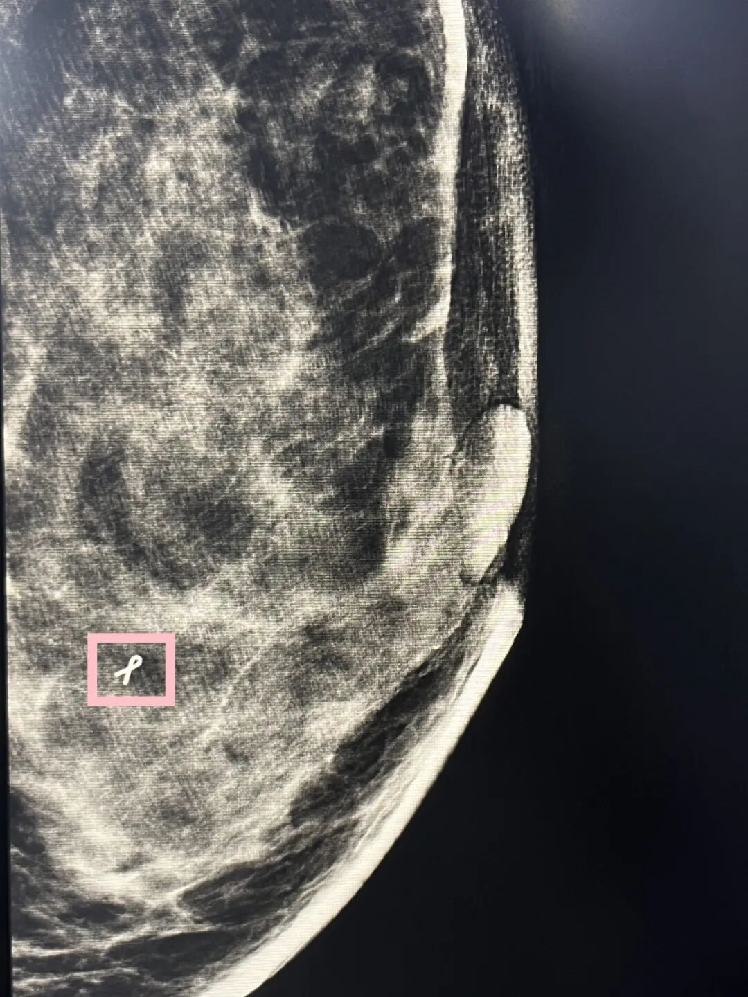 为什么要定位针 乳腺技术·瘤 ｜ 发现乳腺微小钙化灶怎么办？“针孔”活检、定位监测一招搞定！_https://www.jmylbn.com_新闻资讯_第3张