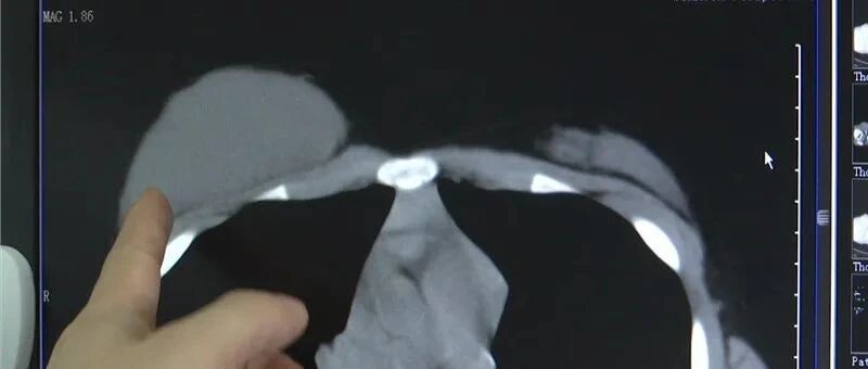 才半年！海宁11岁女孩体内长出手掌大肿瘤！竟和这个日常饮料有关…