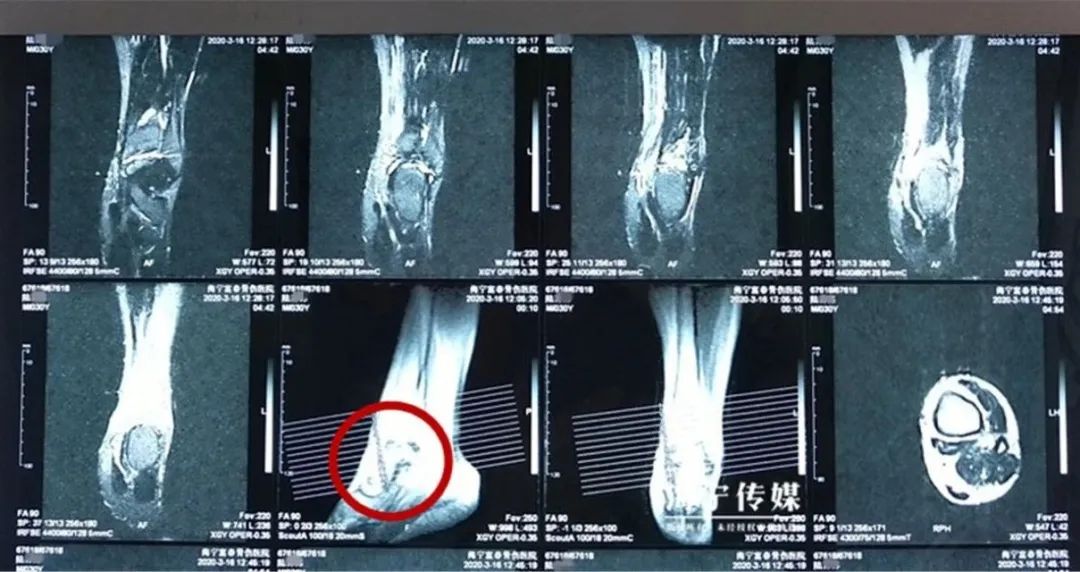 【科普】男子崴了脚不当回事,半年后,可怕的一幕出现了