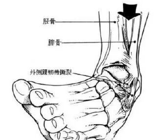 为什么手术后要经常翻身骨科常见疾病术后体位及注意事项_https://www.jmylbn.com_新闻资讯_第12张