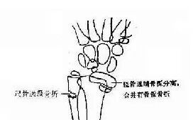 为什么手术后要经常翻身骨科常见疾病术后体位及注意事项_https://www.jmylbn.com_新闻资讯_第6张