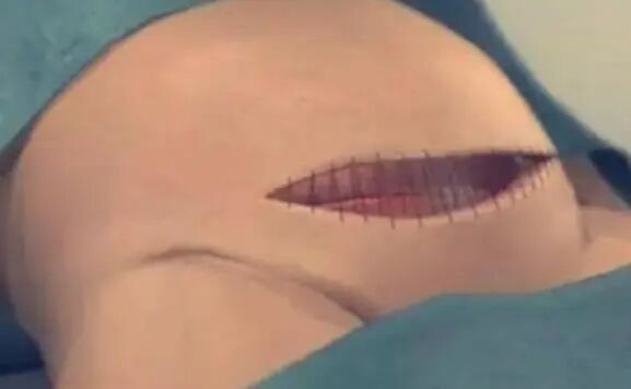 产包有什么器械剖腹产只需打一针就好了？看看这场手术的器械和步骤，不寒而栗_https://www.jmylbn.com_新闻资讯_第9张