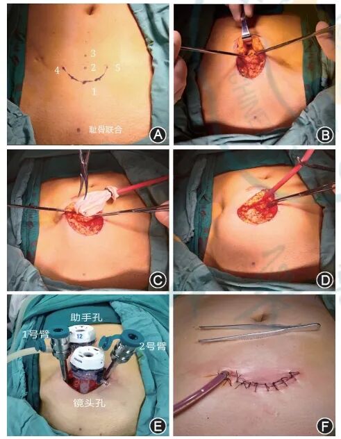 前列腺机器怎么治疗“术”有专攻 ｜ 机器人领航前列腺癌治疗新纪元：我国机器人辅助前列腺癌根治术应用激增，疗效斐然_https://www.jmylbn.com_新闻资讯_第2张