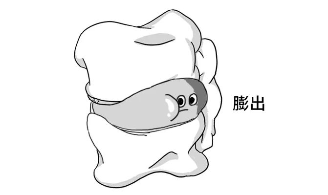 【注意】腰椎間盤突出，就像婆媳矛盾，3 招幫你解決 健康 第9張