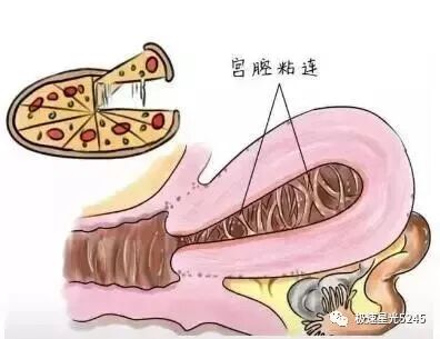 子宫球囊支架怎么取一次性使用三角球囊子宫支架友情提醒：你以为的月经不调，有可能是宫腔粘连_https://www.jmylbn.com_新闻资讯_第1张