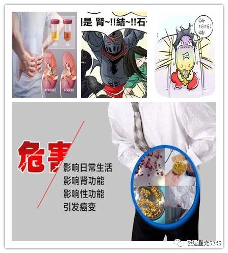 取石网篮 为什么贵天气转暖，易得肾结石？-竹海牌一次性取石网篮助你脱离困境_https://www.jmylbn.com_新闻资讯_第2张