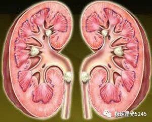 取石网篮 为什么贵天气转暖，易得肾结石？-竹海牌一次性取石网篮助你脱离困境_https://www.jmylbn.com_新闻资讯_第1张