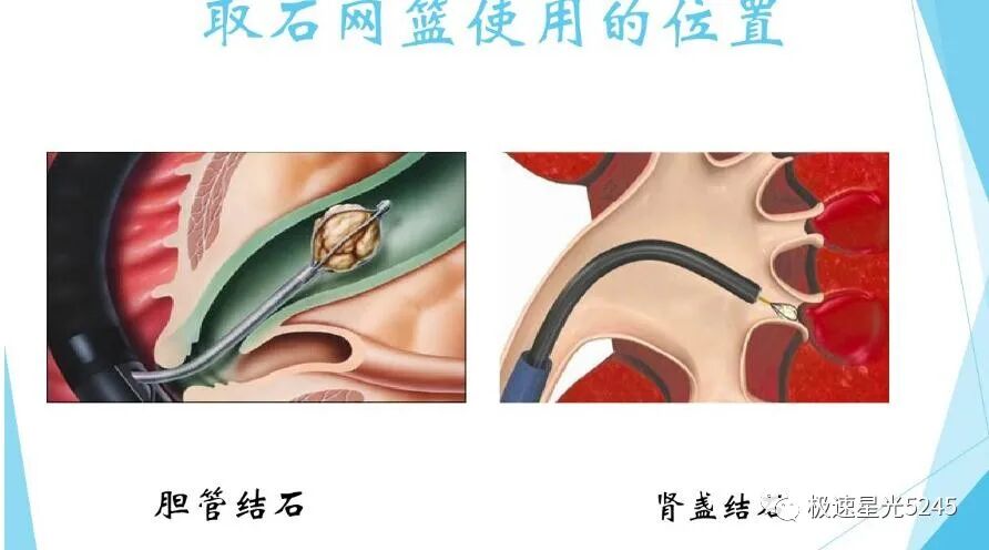 取石网篮 为什么贵天气转暖，易得肾结石？-竹海牌一次性取石网篮助你脱离困境_https://www.jmylbn.com_新闻资讯_第5张