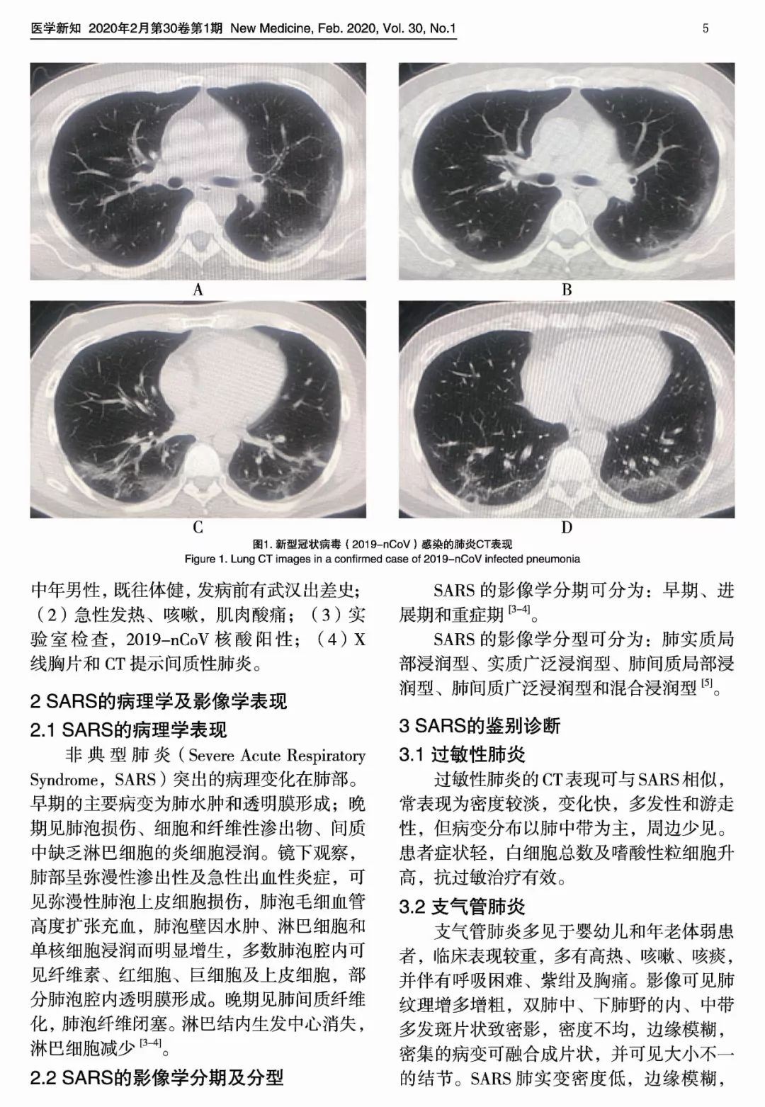 1例确诊新型冠状病毒 2019 Ncov 肺炎患者的肺部ct表现 解说国自然