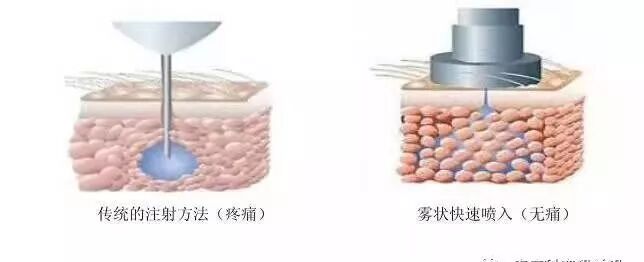 枪针怎么用医用麻醉枪拆卸安装保养维护使用大全【收藏】_https://www.jmylbn.com_新闻资讯_第2张