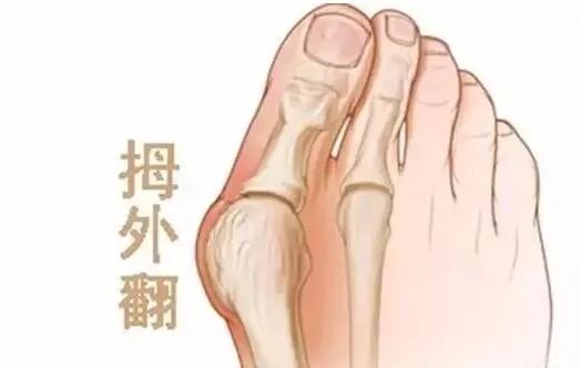 医用磨钻什么牌子好微创拇外翻专用设备-医用电动磨钻_https://www.jmylbn.com_新闻资讯_第39张