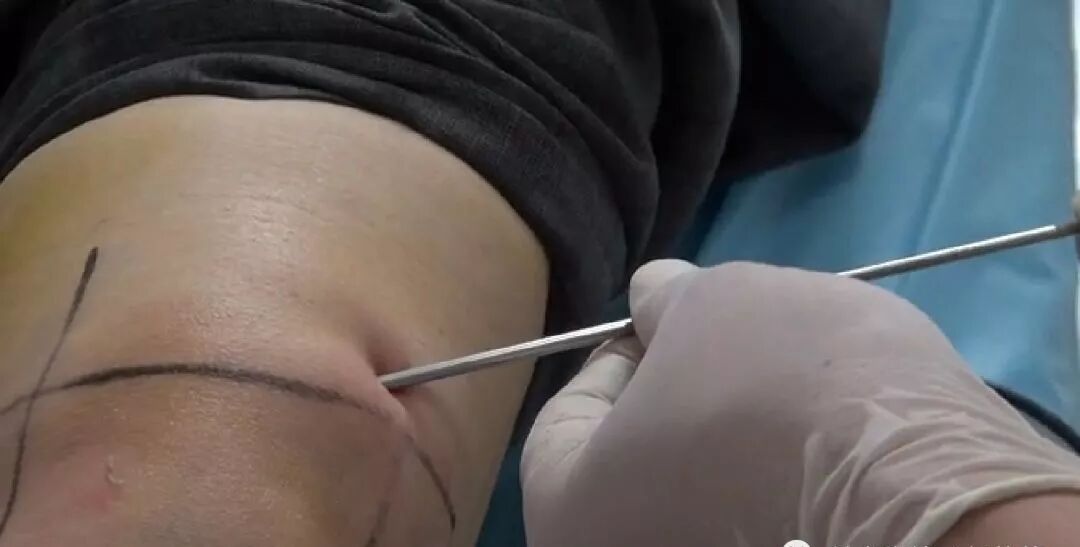 冲洗针怎么用视频膝关节冲洗（灌洗）的具体方法（收藏）_https://www.jmylbn.com_新闻资讯_第3张