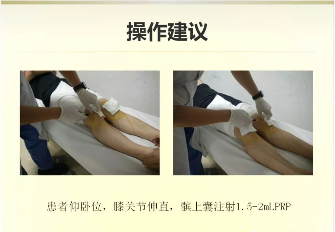 冲洗针怎么用视频膝关节冲洗（灌洗）的具体方法（收藏）_https://www.jmylbn.com_新闻资讯_第2张