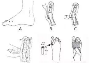 医用磨钻什么牌子好微创拇外翻专用设备-医用电动磨钻_https://www.jmylbn.com_新闻资讯_第17张