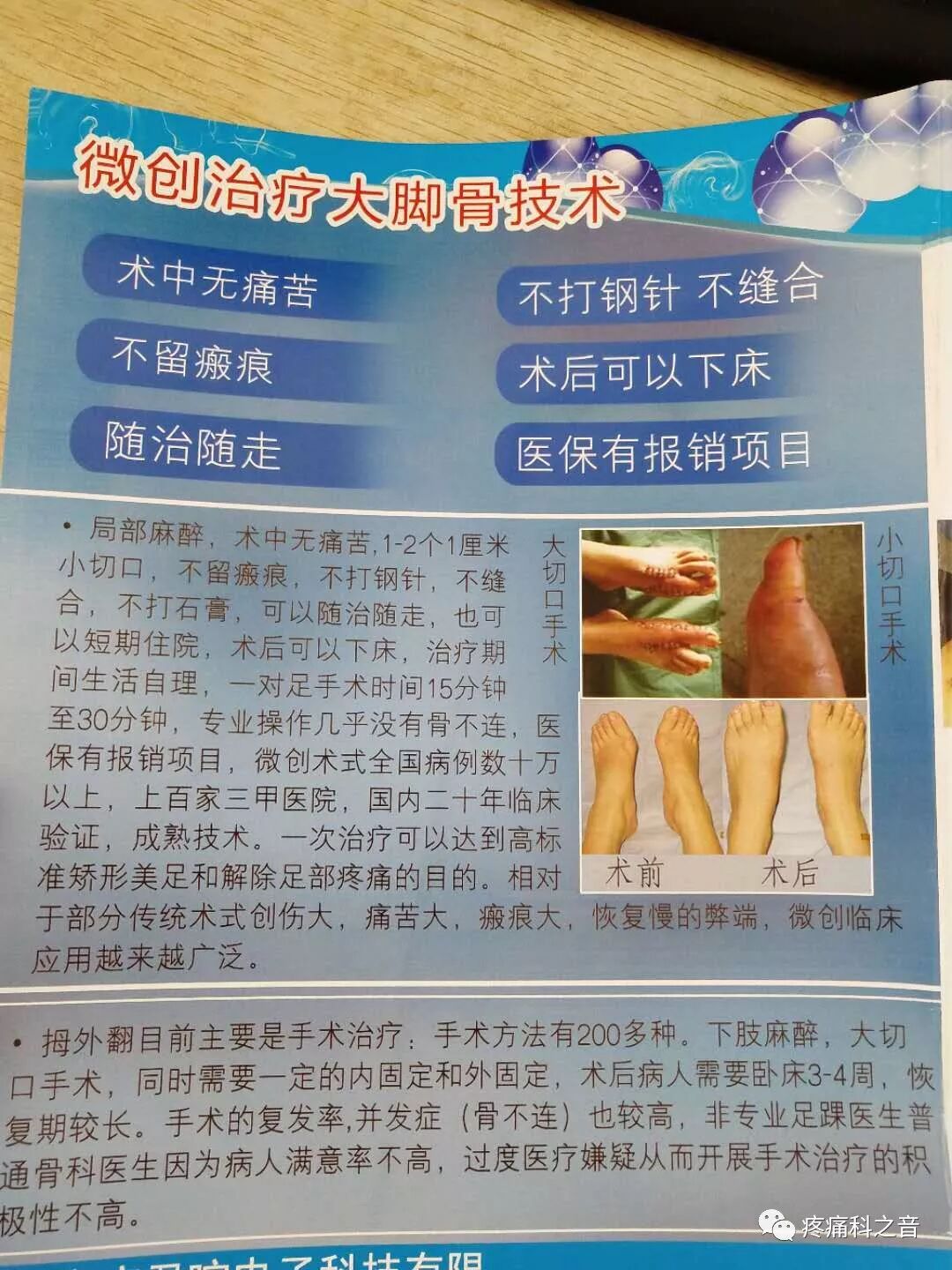 医用磨钻什么牌子好微创拇外翻专用设备-医用电动磨钻_https://www.jmylbn.com_新闻资讯_第27张