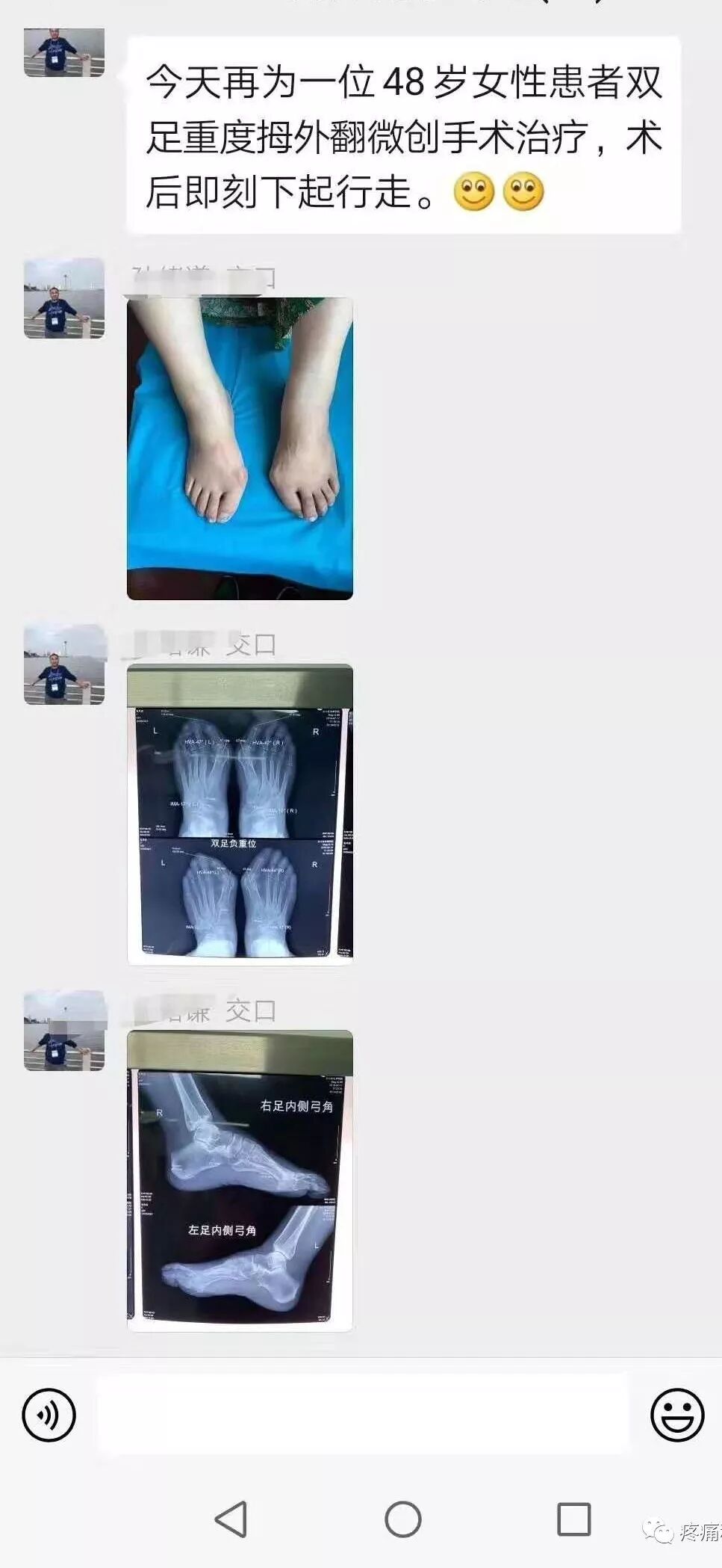 医用磨钻什么牌子好微创拇外翻专用设备-医用电动磨钻_https://www.jmylbn.com_新闻资讯_第30张