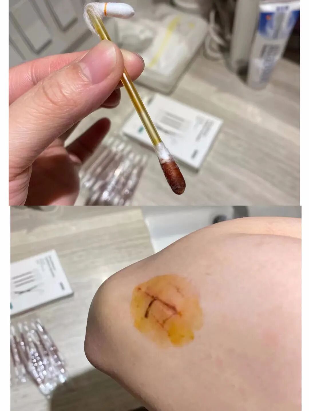 一次性碘伏棉签怎么用②FEROLAN一次性碘伏／酒精棉签(2盒)｜除菌、护理二合一，超省心，家庭药箱必备_https://www.jmylbn.com_新闻资讯_第21张