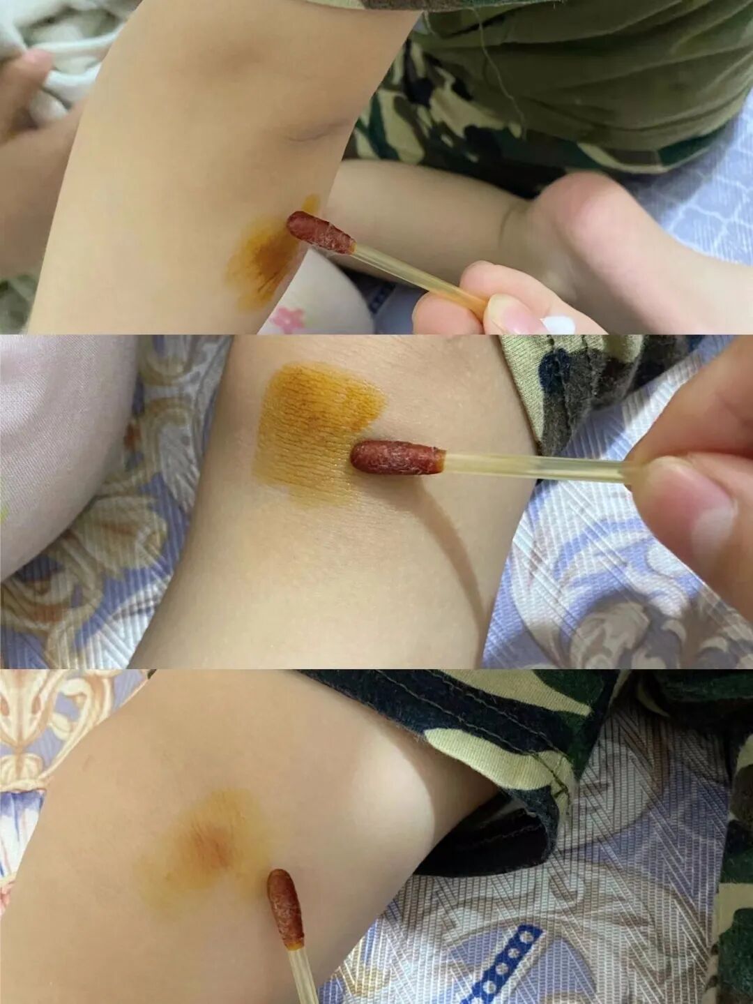 一次性碘伏棉签怎么用②FEROLAN一次性碘伏／酒精棉签(2盒)｜除菌、护理二合一，超省心，家庭药箱必备_https://www.jmylbn.com_新闻资讯_第24张