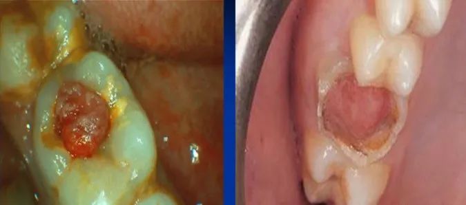 牙髓息肉的处理方法