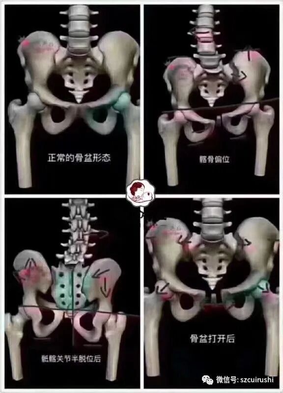 骨盆修复的好处多多，不仅可以提臀还可以恢复苗条身材