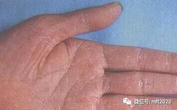 手癣的症状和特点