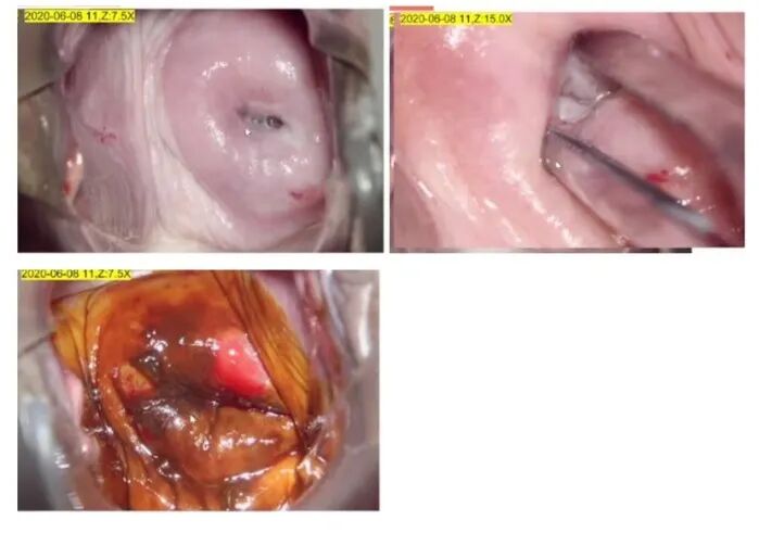 宫颈活检取样怎么取每周一课第14期精彩分享｜杨勇霞教授：绝经后宫颈筛查及异常结果管理相关问题探讨_https://www.jmylbn.com_新闻资讯_第12张