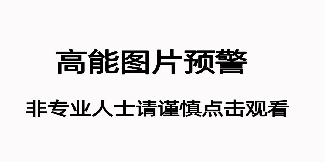 宫颈活检取样怎么取每周一课第14期精彩分享｜杨勇霞教授：绝经后宫颈筛查及异常结果管理相关问题探讨_https://www.jmylbn.com_新闻资讯_第3张