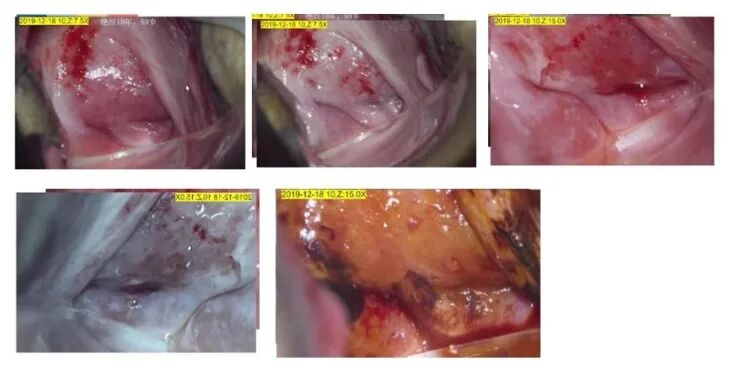 宫颈活检取样怎么取每周一课第14期精彩分享｜杨勇霞教授：绝经后宫颈筛查及异常结果管理相关问题探讨_https://www.jmylbn.com_新闻资讯_第8张
