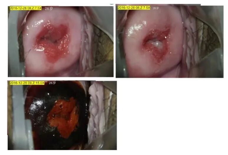宫颈活检取样怎么取每周一课第14期精彩分享｜杨勇霞教授：绝经后宫颈筛查及异常结果管理相关问题探讨_https://www.jmylbn.com_新闻资讯_第4张
