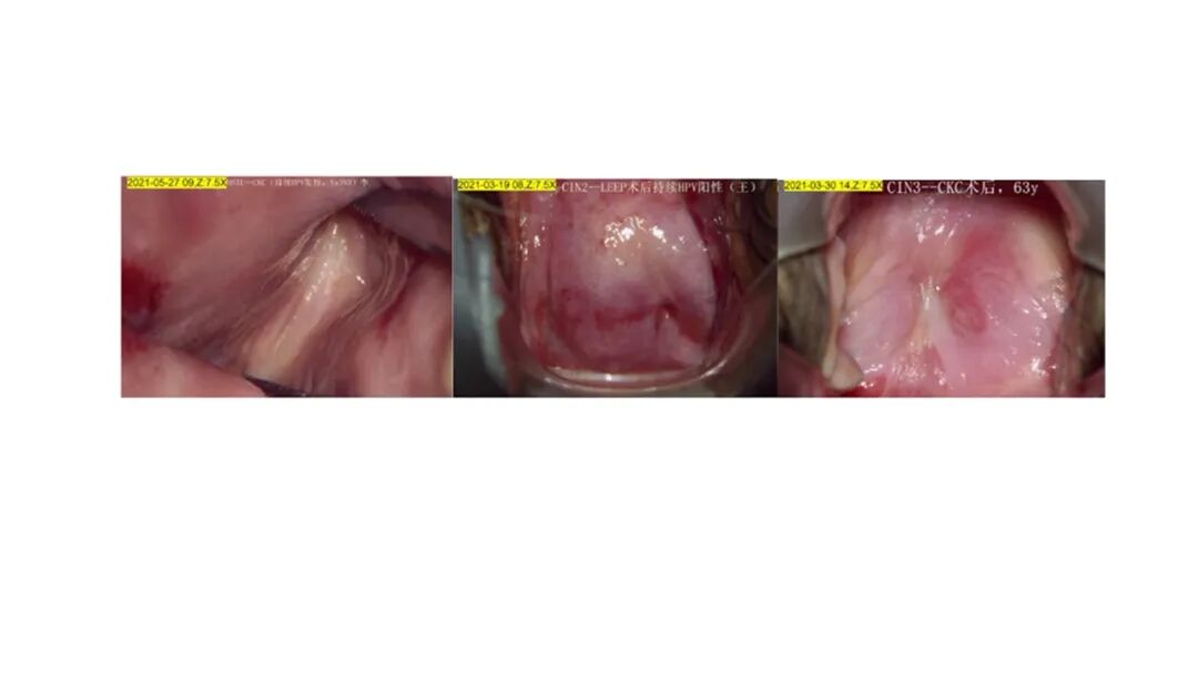 宫颈活检取样怎么取每周一课第14期精彩分享｜杨勇霞教授：绝经后宫颈筛查及异常结果管理相关问题探讨_https://www.jmylbn.com_新闻资讯_第18张