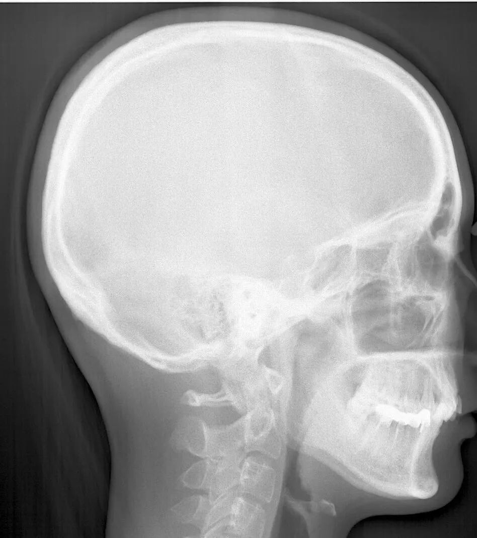 口腔ct怎么看拍了牙片怎么看？一分钟教会你快速看懂_https://www.jmylbn.com_新闻资讯_第4张