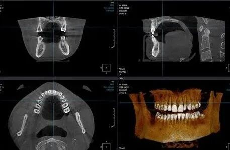 口腔ct怎么看拍了牙片怎么看？一分钟教会你快速看懂_https://www.jmylbn.com_新闻资讯_第5张