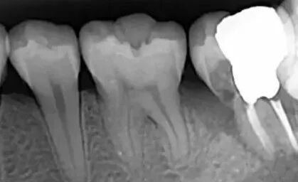 口腔ct怎么看拍了牙片怎么看？一分钟教会你快速看懂_https://www.jmylbn.com_新闻资讯_第2张