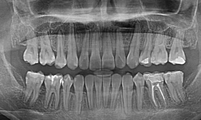 口腔ct怎么看拍了牙片怎么看？一分钟教会你快速看懂_https://www.jmylbn.com_新闻资讯_第3张